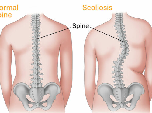 Scoliosis-treatment