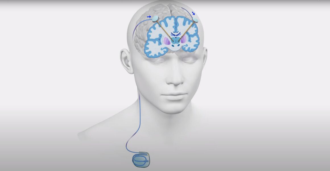 Deep Brain Stimulation for Parkinson’s Disease: Know Everything About It!