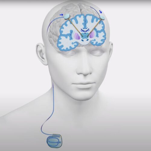 Deep Brain Stimulation for Parkinson’s Disease: Know Everything About It!